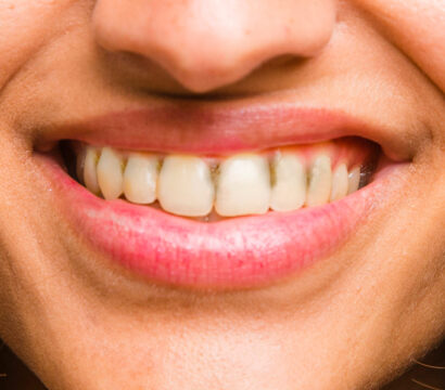 Black Spots on Teeth: 10 Surprising Causes and Effective Treatment