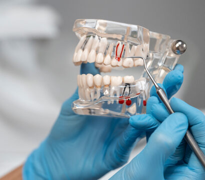 How to Prepare for a Root Canal During Pregnancy