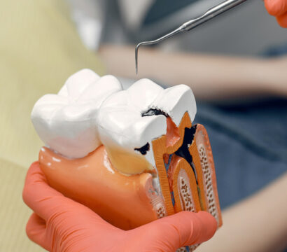 Root Canal for Molars