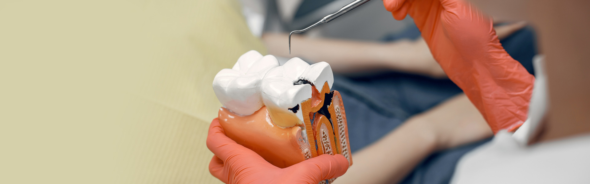 Root Canal for Molars