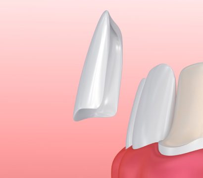 The-Ultimate-Guide-to-Porcelain-Veneers-Smile-Transformation-in-Ellicott-City