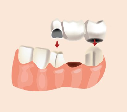 How Dental Bridges Can Help Improve Your Oral Health and Appearance