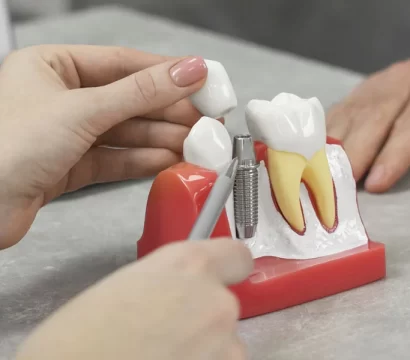 Why Full Mouth Dental Implants Are the Best Long-Term Solution in Ellicott City, MD