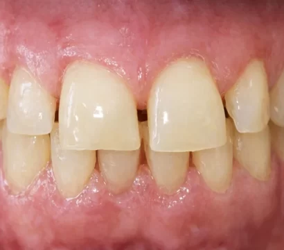 invisalign dentist ellicott city