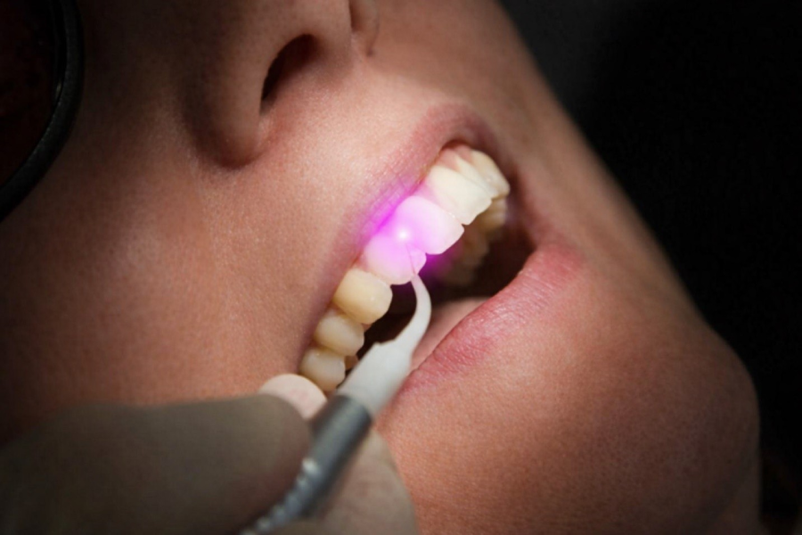 Laser dentistry services