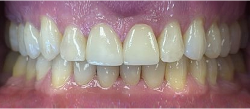 After image