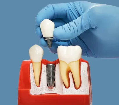What Happens During a Dental Implant Consultation? Step-by-Step Explanation